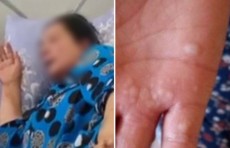 Жительница Андижанской области поступила в больницу с подозрением на вирус оспы обезьян